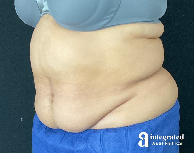 Tummy Tuck Before & After Gallery - Patient 133213465 - Image 3
