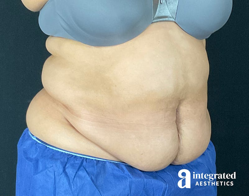 Tummy Tuck Before & After Gallery - Patient 133213465 - Image 5