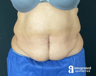 Tummy Tuck Before & After Gallery - Patient 133213465 - Image 1