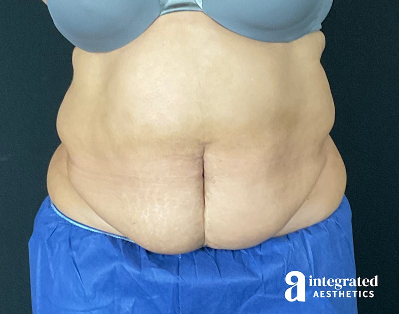 Tummy Tuck Before & After Gallery - Patient 133213465 - Image 1