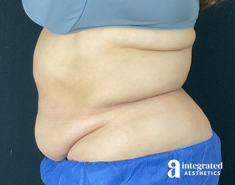 Tummy Tuck Before & After Gallery - Patient 133213465 - Image 7