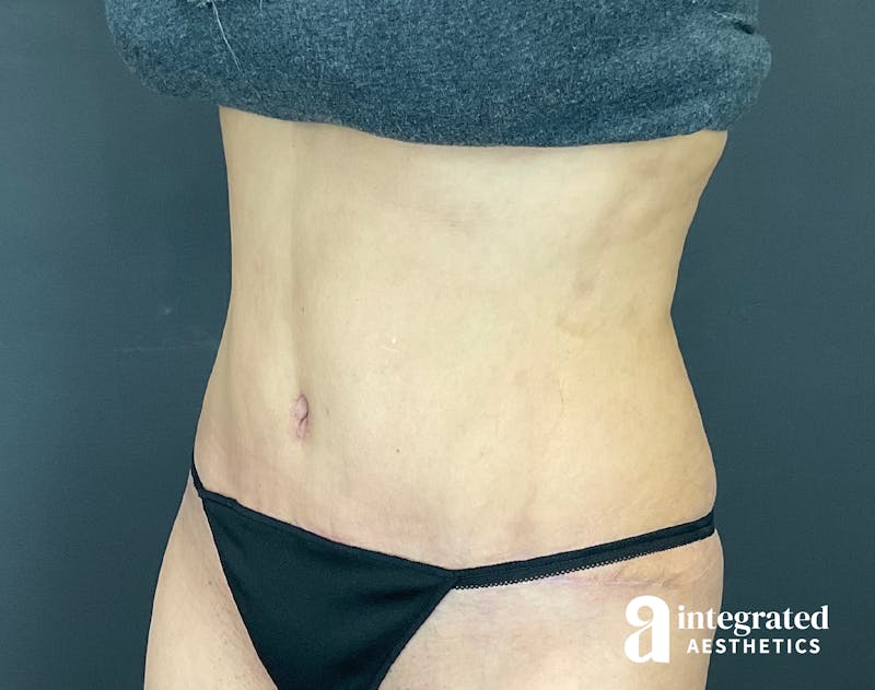 Tummy Tuck Before & After Gallery - Patient 133213479 - Image 4