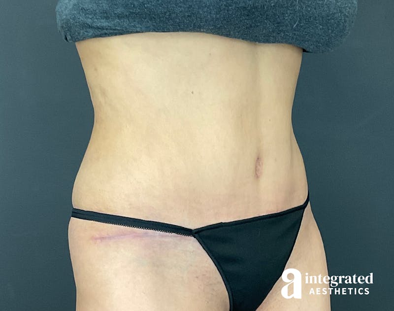 Tummy Tuck Before & After Gallery - Patient 133213479 - Image 6
