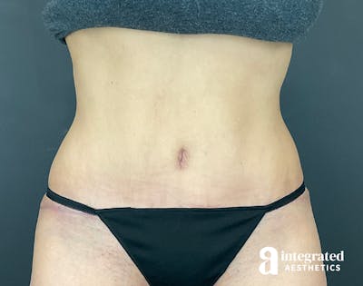 Tummy Tuck Before & After Gallery - Patient 133213479 - Image 2