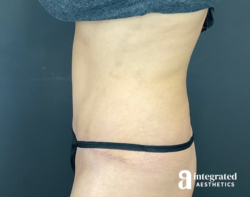 Tummy Tuck Before & After Gallery - Patient 133213479 - Image 8