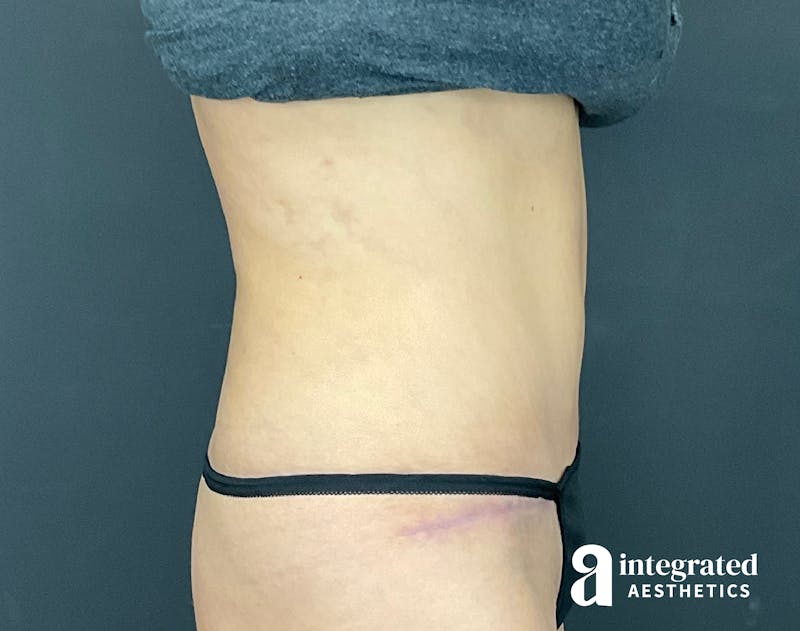 Tummy Tuck Before & After Gallery - Patient 133213479 - Image 10