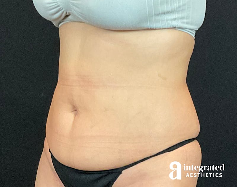 Tummy Tuck Before & After Gallery - Patient 133213479 - Image 3
