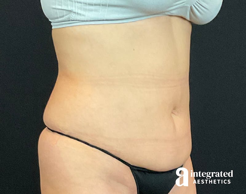 Tummy Tuck Before & After Gallery - Patient 133213479 - Image 5