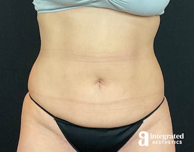 Tummy Tuck Before & After Gallery - Patient 133213479 - Image 1