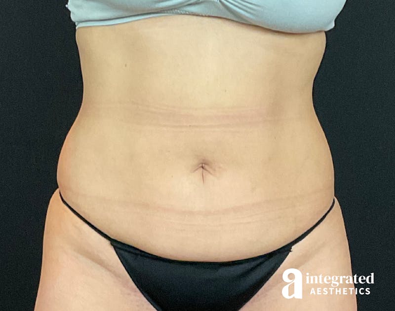Tummy Tuck Before & After Gallery - Patient 133213479 - Image 1