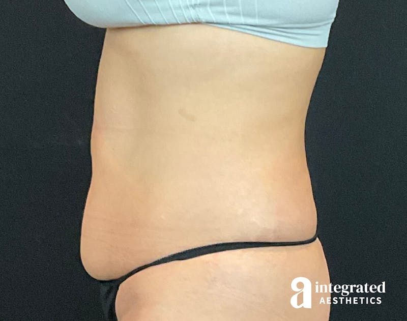 Tummy Tuck Before & After Gallery - Patient 133213479 - Image 7