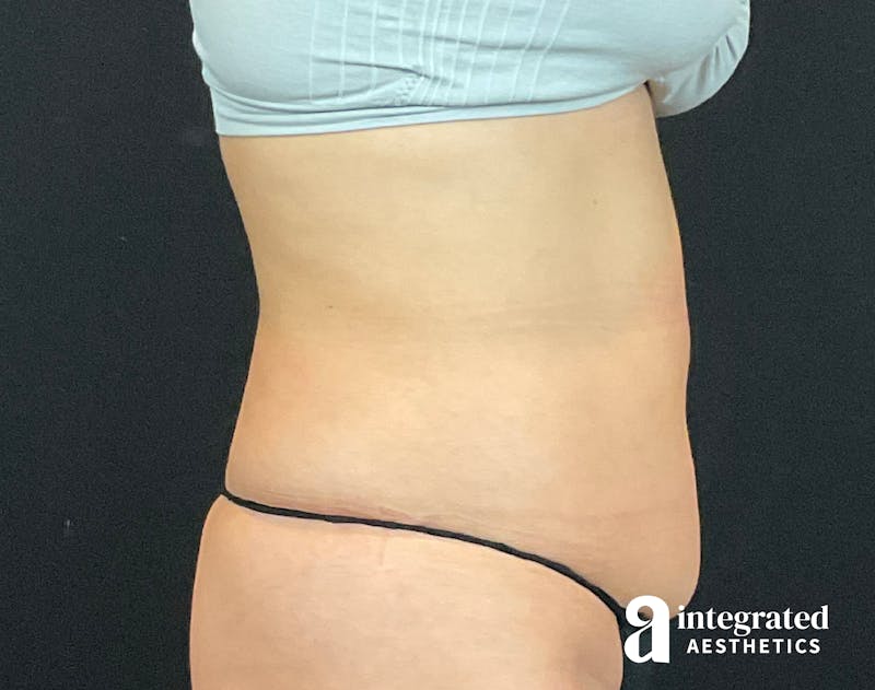 Tummy Tuck Before & After Gallery - Patient 133213479 - Image 9