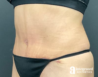 Tummy Tuck Before & After Gallery - Patient 133213530 - Image 2