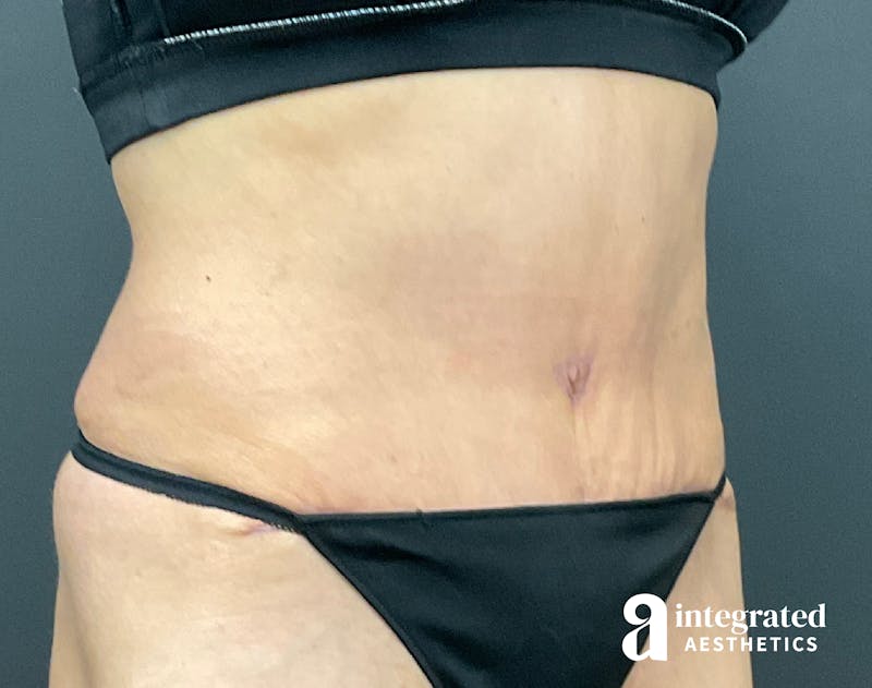 Tummy Tuck Before & After Gallery - Patient 133213530 - Image 4