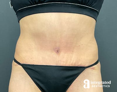 Tummy Tuck Before & After Gallery - Patient 133213530 - Image 2
