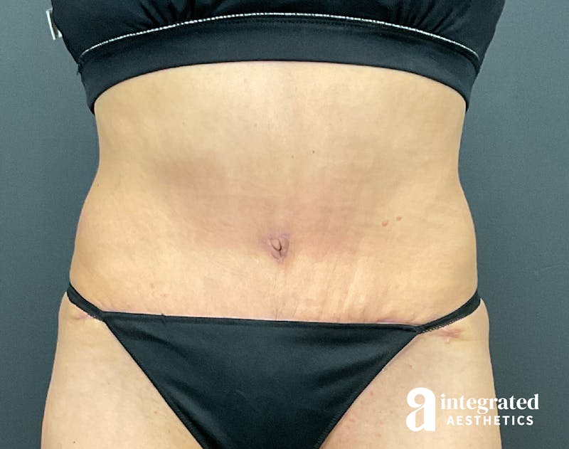 Tummy Tuck Before & After Gallery - Patient 133213530 - Image 2