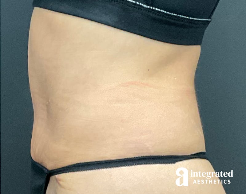 Tummy Tuck Before & After Gallery - Patient 133213530 - Image 6