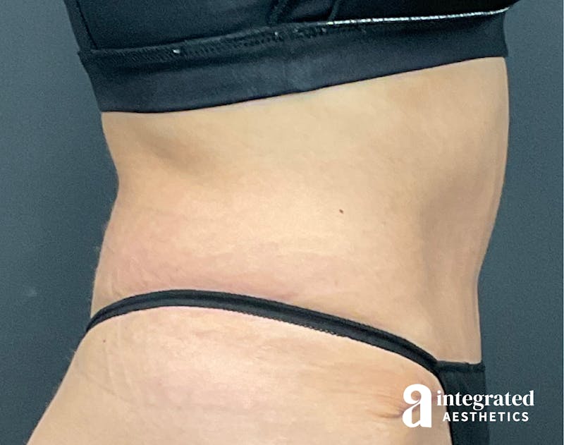 Tummy Tuck Before & After Gallery - Patient 133213530 - Image 8