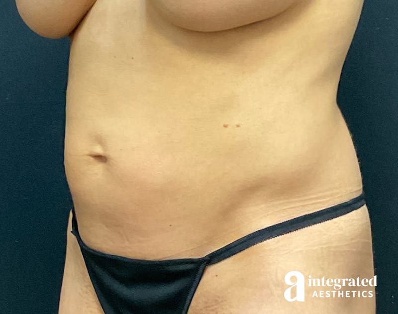 Tummy Tuck Before & After Gallery - Patient 133213530 - Image 3