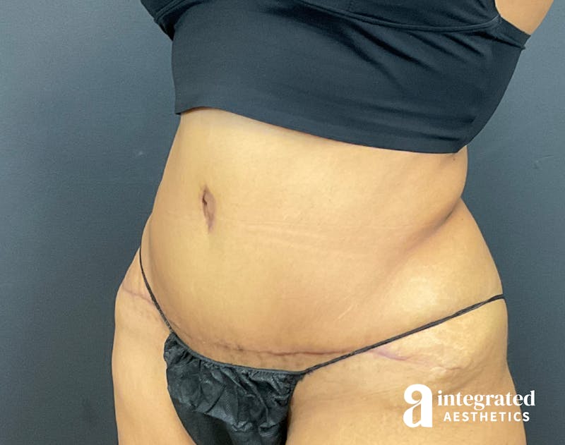 Tummy Tuck Before & After Gallery - Patient 133213529 - Image 4