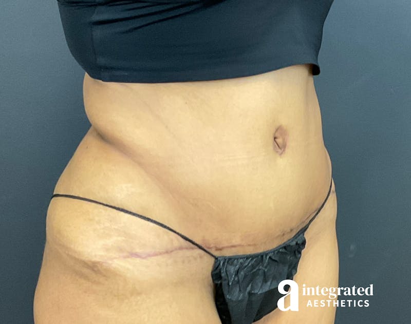 Tummy Tuck Before & After Gallery - Patient 133213529 - Image 6