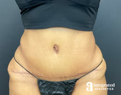Tummy Tuck Before & After Gallery - Patient 133213529 - Image 2
