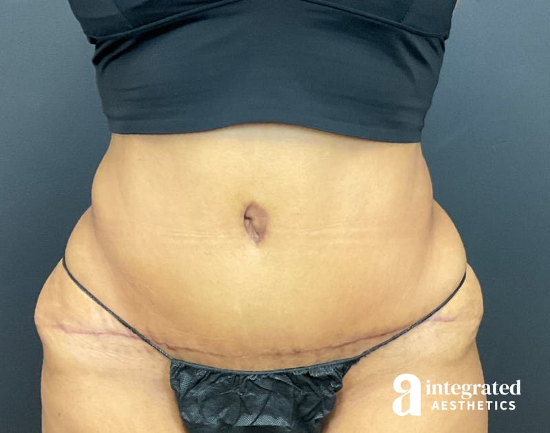 Tummy Tuck Before & After Gallery - Patient 133213529 - Image 2