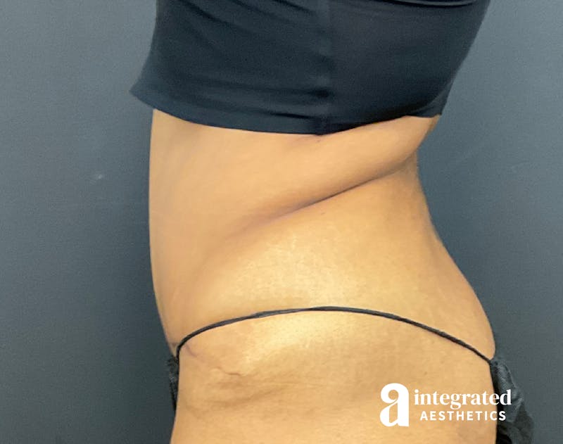 Tummy Tuck Before & After Gallery - Patient 133213529 - Image 8