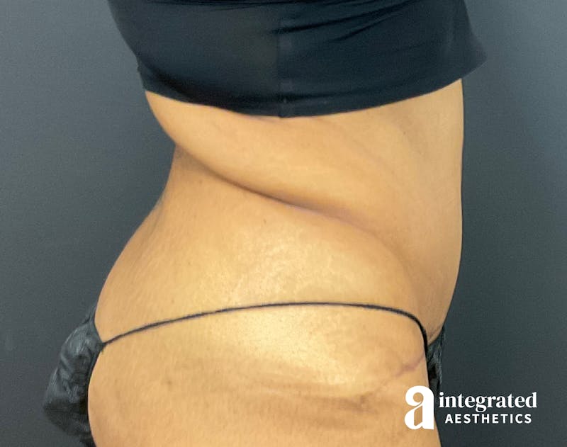 Tummy Tuck Before & After Gallery - Patient 133213529 - Image 10