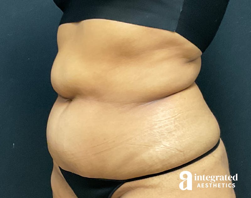 Tummy Tuck Before & After Gallery - Patient 133213529 - Image 3