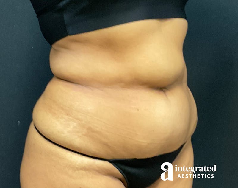 Tummy Tuck Before & After Gallery - Patient 133213529 - Image 5