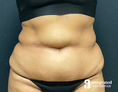 Tummy Tuck Before & After Gallery - Patient 133213529 - Image 1
