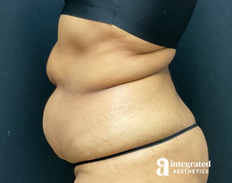 Tummy Tuck Before & After Gallery - Patient 133213529 - Image 7