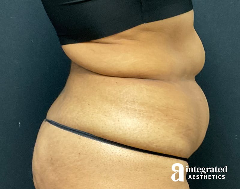 Tummy Tuck Before & After Gallery - Patient 133213529 - Image 9
