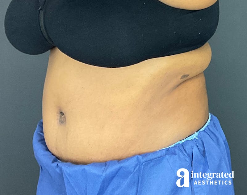 Tummy Tuck Before & After Gallery - Patient 133213528 - Image 4