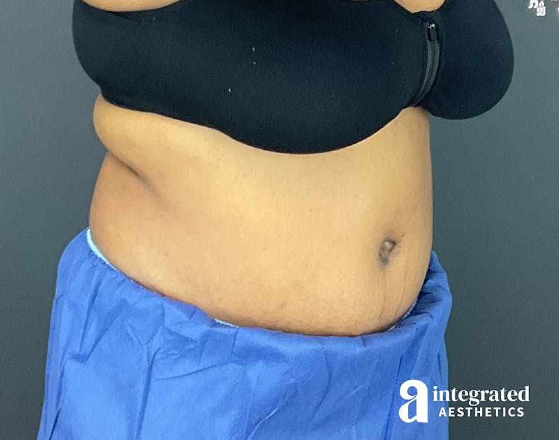 Tummy Tuck Before & After Gallery - Patient 133213528 - Image 6