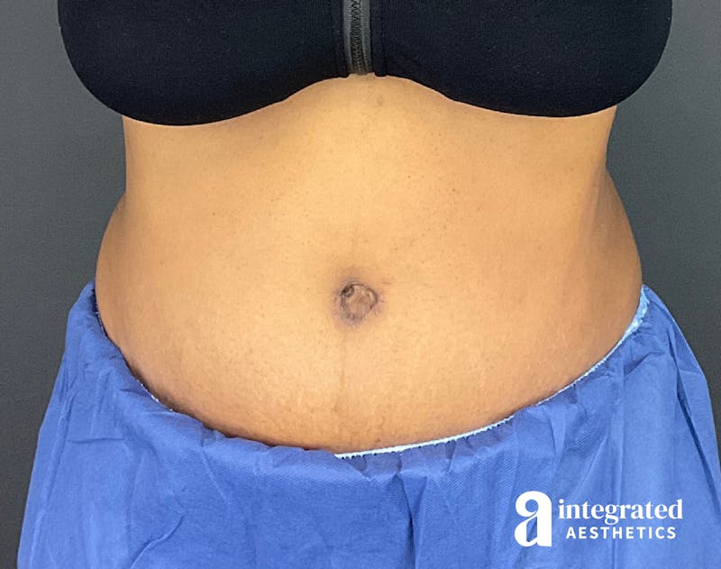 Tummy Tuck Before & After Gallery - Patient 133213528 - Image 2