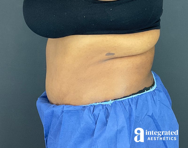 Tummy Tuck Before & After Gallery - Patient 157150376 - Image 12