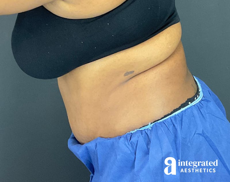 Tummy Tuck Before & After Gallery - Patient 133213528 - Image 10