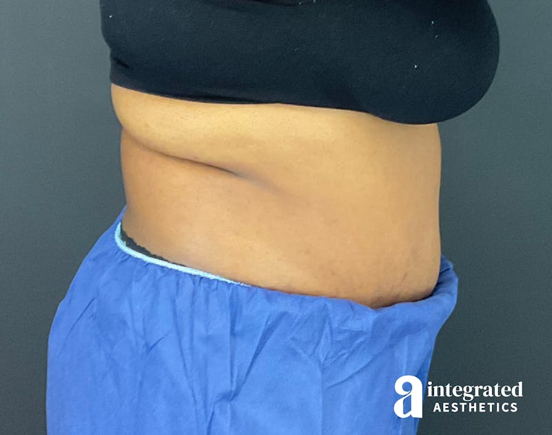 Tummy Tuck Before & After Gallery - Patient 133213528 - Image 12