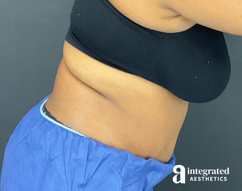 Tummy Tuck Before & After Gallery - Patient 157150376 - Image 8