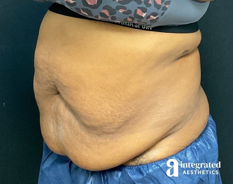Tummy Tuck Before & After Gallery - Patient 157150376 - Image 9