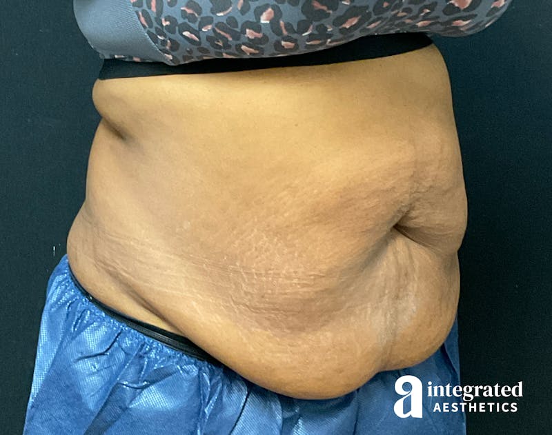 Tummy Tuck Before & After Gallery - Patient 157150376 - Image 3