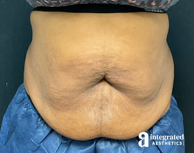 Tummy Tuck Before & After Gallery - Patient 133213528 - Image 1