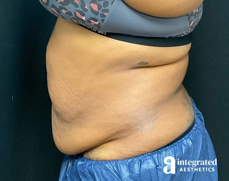 Tummy Tuck Before & After Gallery - Patient 157150376 - Image 11