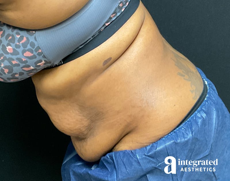 Tummy Tuck Before & After Gallery - Patient 157150376 - Image 13