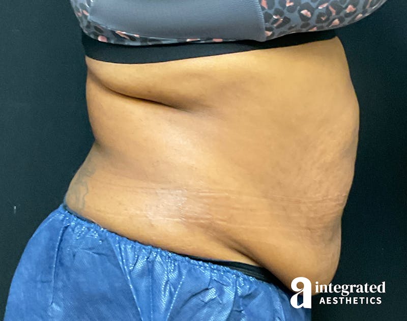 Tummy Tuck Before & After Gallery - Patient 157150376 - Image 5