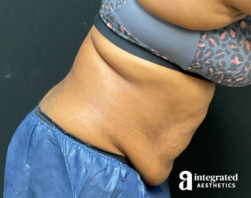 Tummy Tuck Before & After Gallery - Patient 157150376 - Image 7