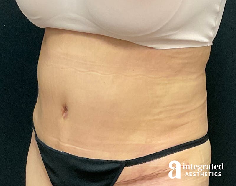 Tummy Tuck Before & After Gallery - Patient 133213527 - Image 4