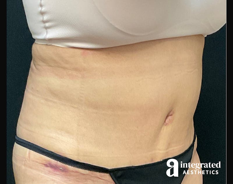 Tummy Tuck Before & After Gallery - Patient 133213527 - Image 6